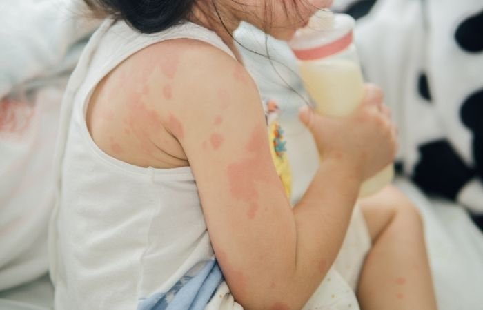 Food Allergies in Kids