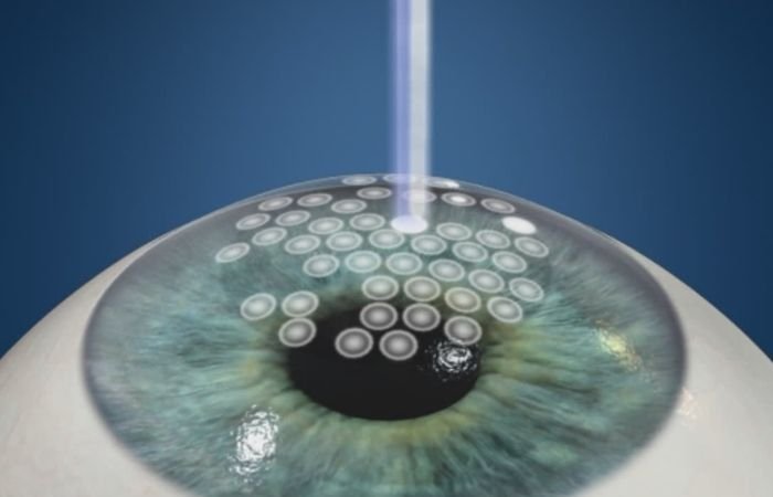 What Is PRK How It Is Different From LASIK